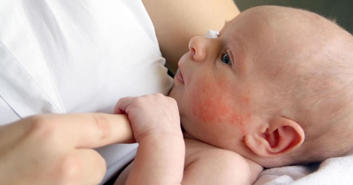 [Eczema em bebês e crianças: os sinais e o tratamento]
