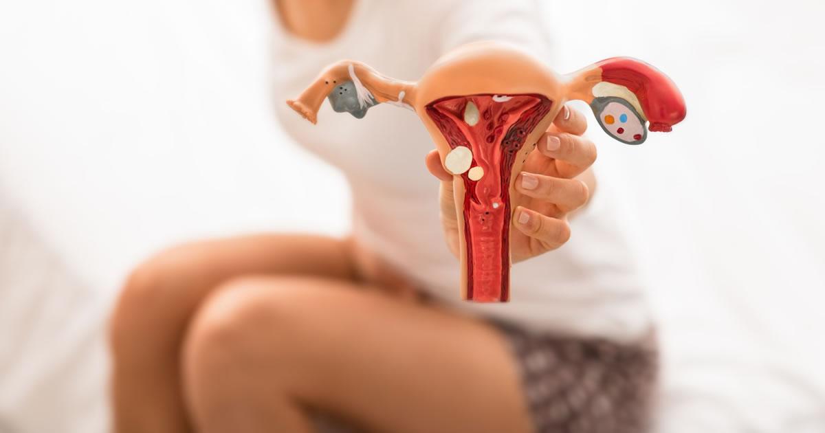 [Endometriose: o que é, sintomas e se tem cura]